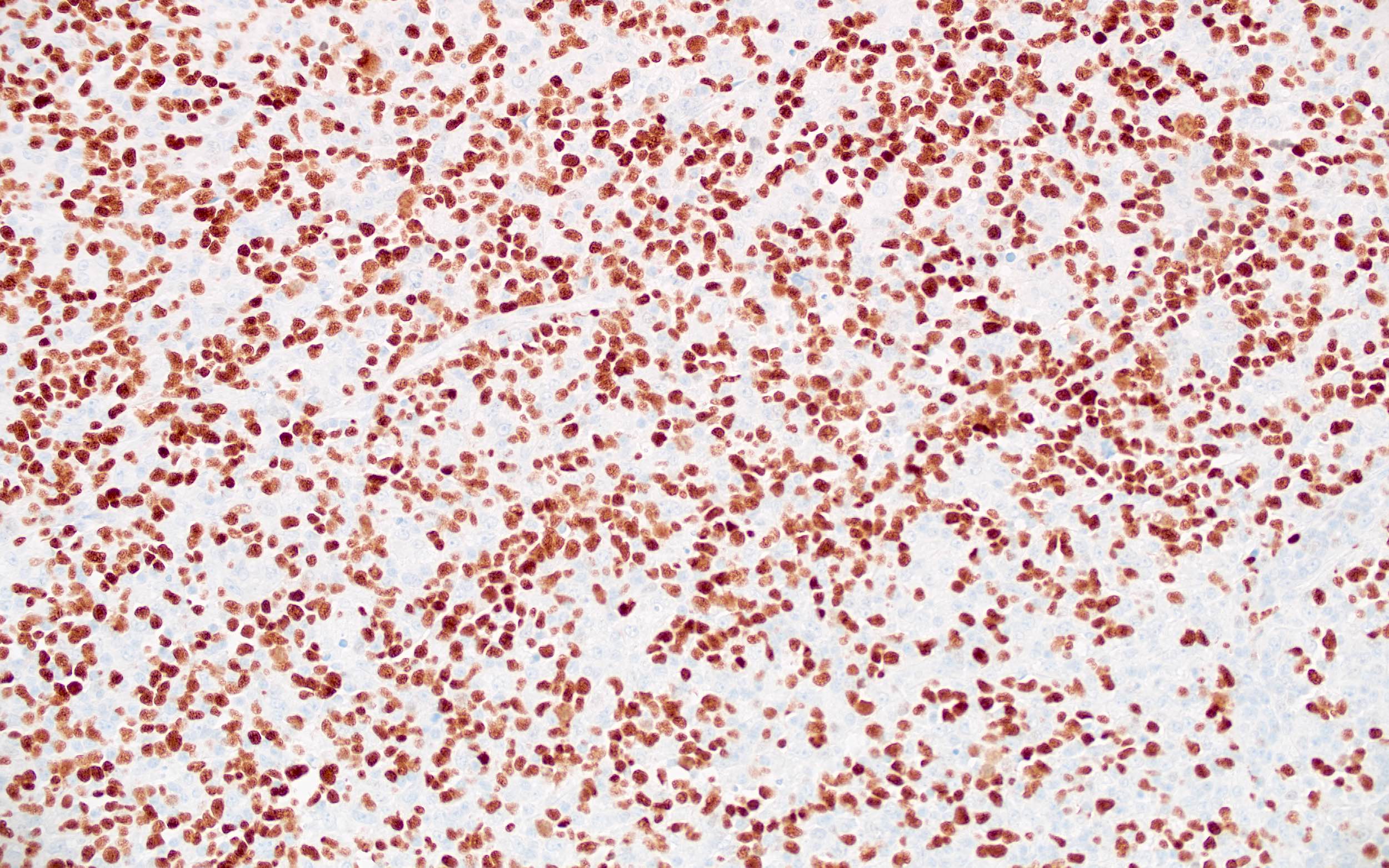 Large atypical cells of DLBCL, OCT2+