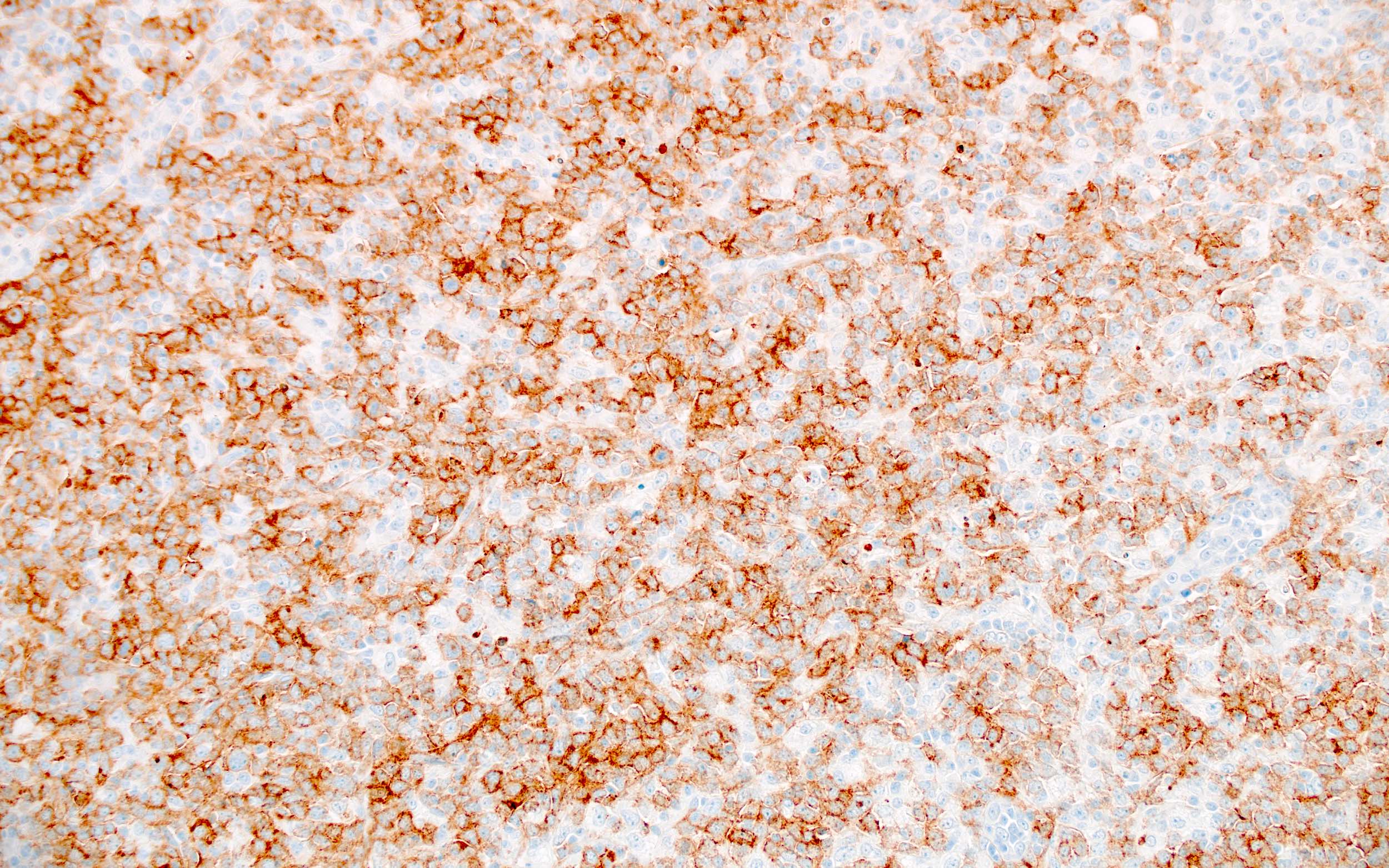 Large atypical cells of DLBCL, CD10+