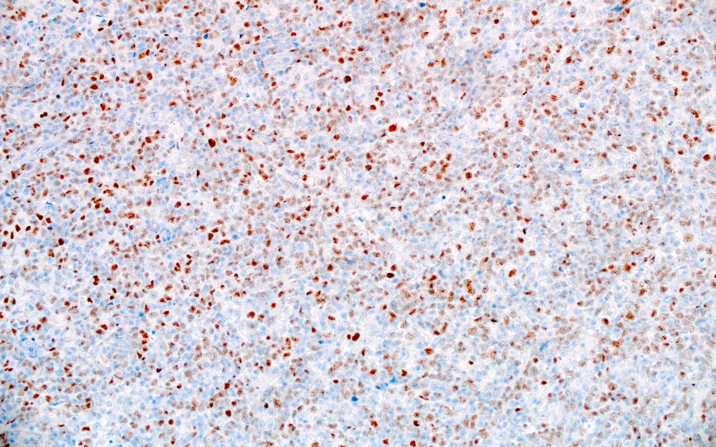 Large atypical cells of DLBCL, BCL6+