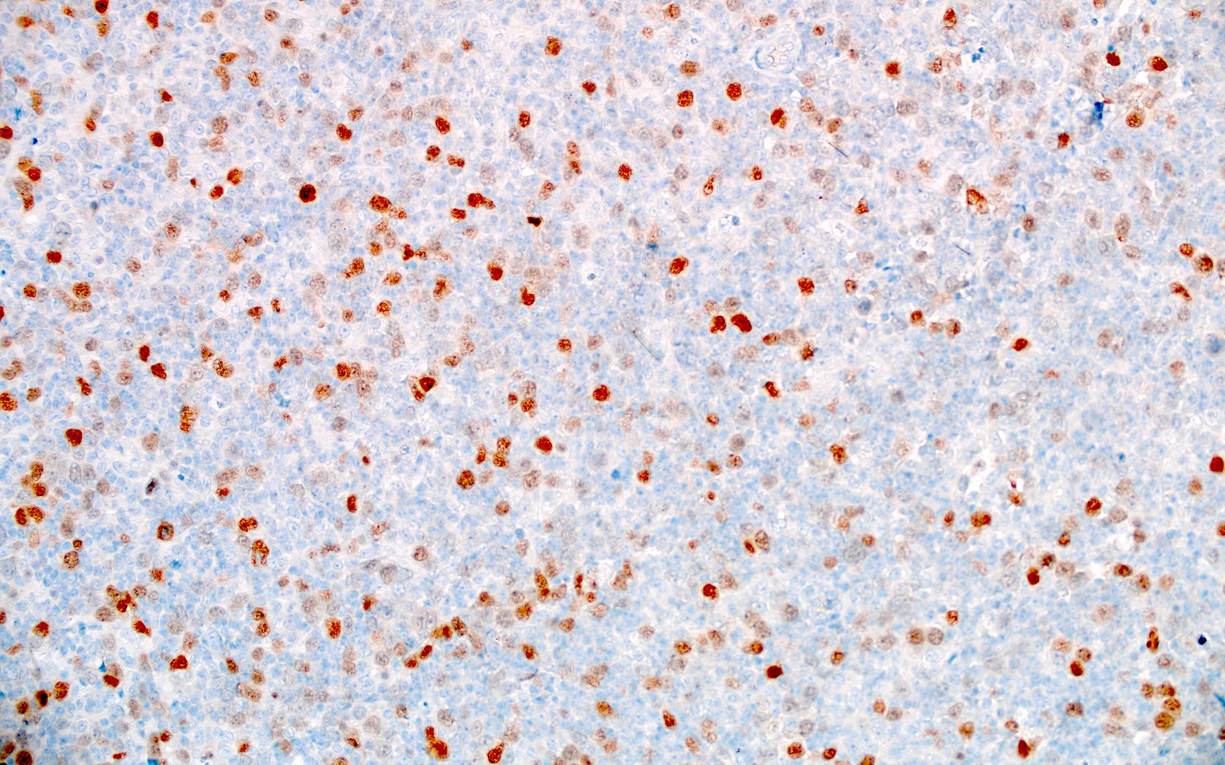 Large atypical cells of DLBCL, MUM1 variable