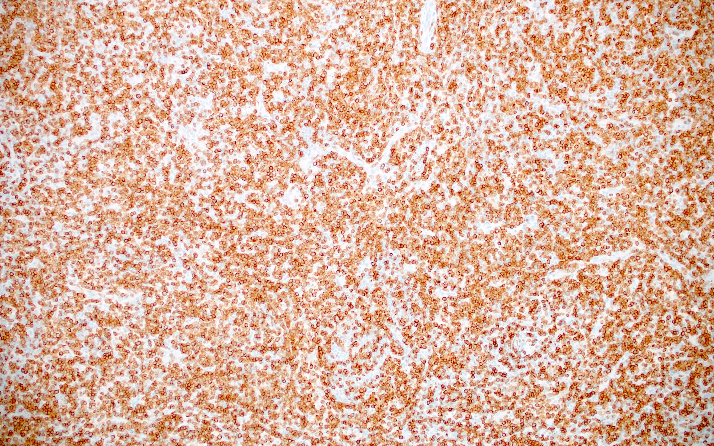 Atypical cells of AITL, CD3+