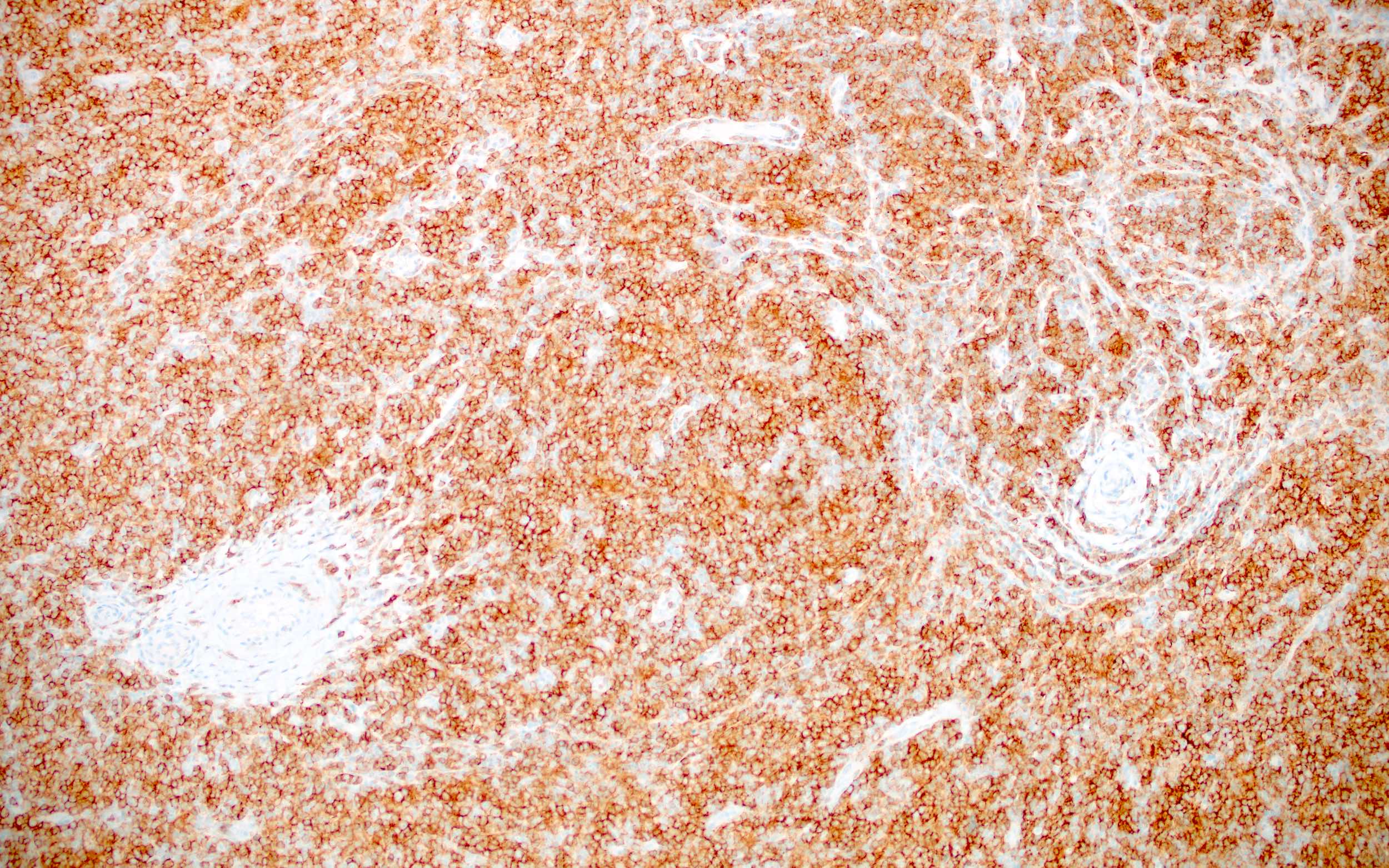Atypical cells of AITL, CD4+