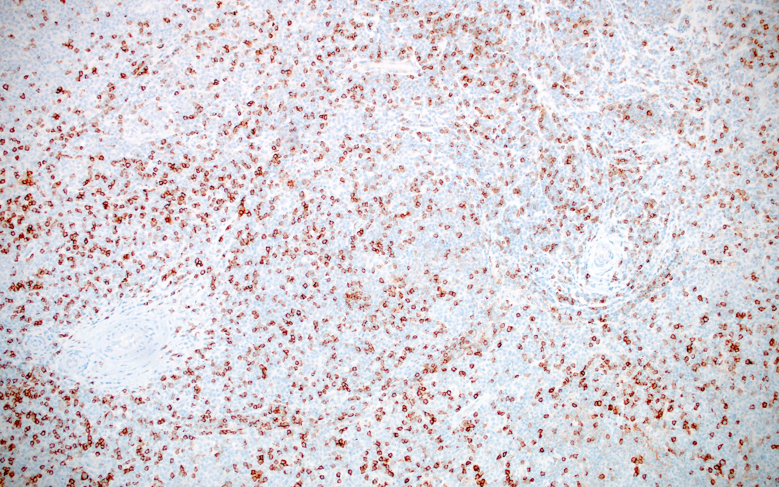 Atypical cells of AITL, CD8-