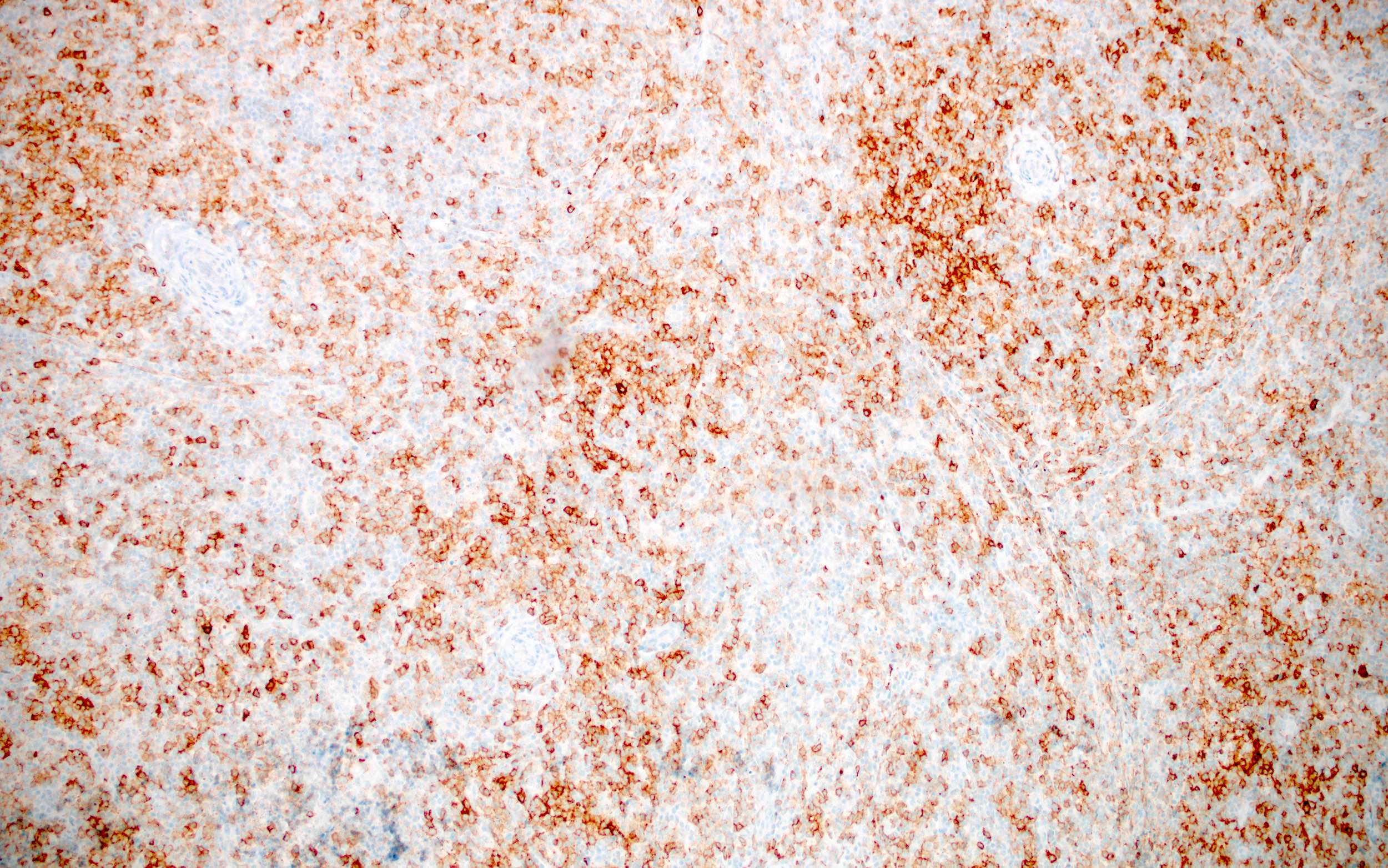 Atypical cells of AITL, CD10+