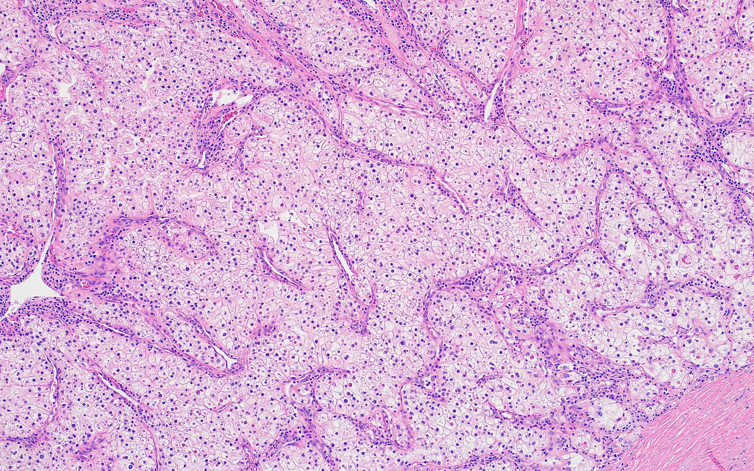 Minimally atypical cells of CCRCC