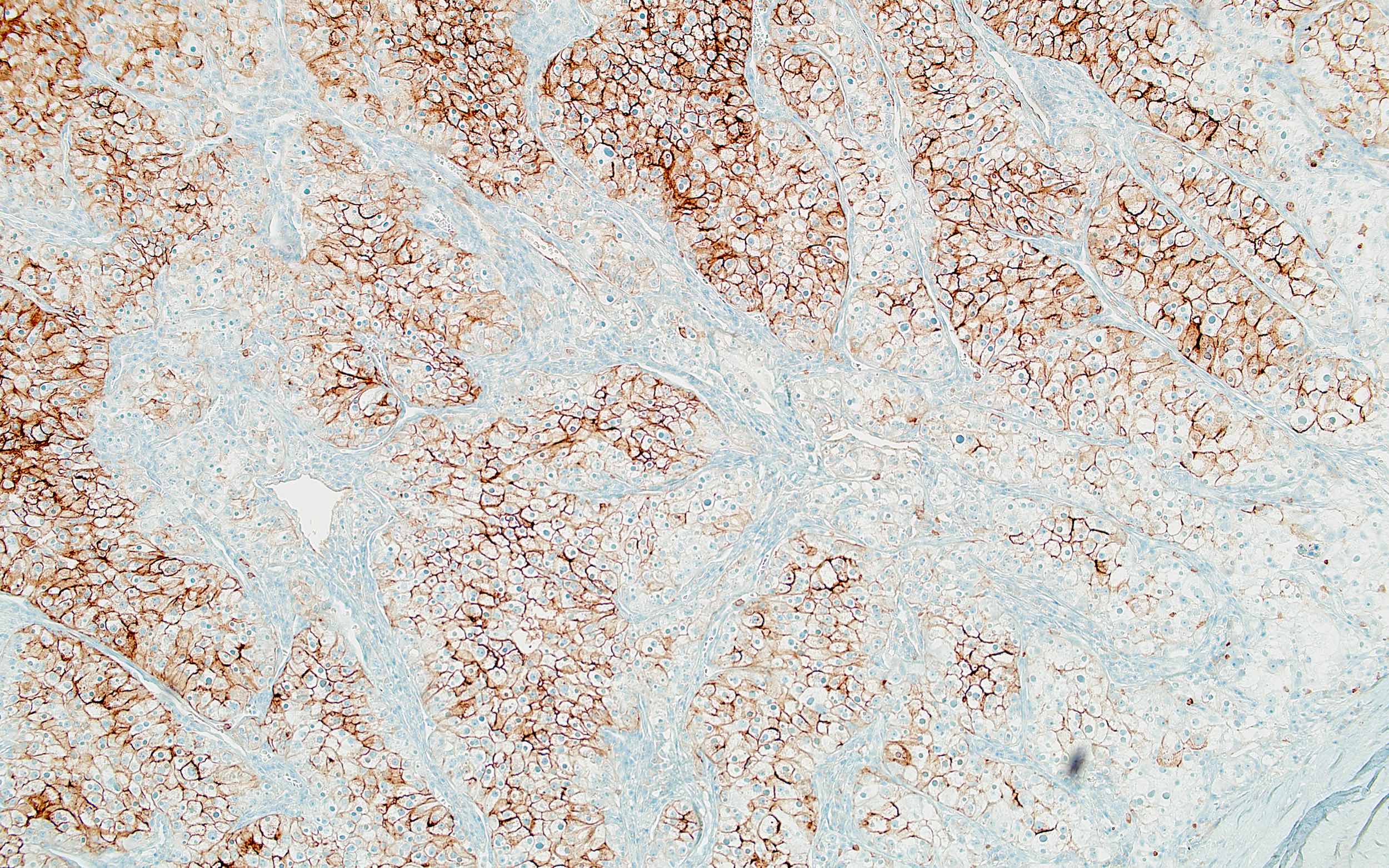 Atypical cells of CCRCC, CD10+