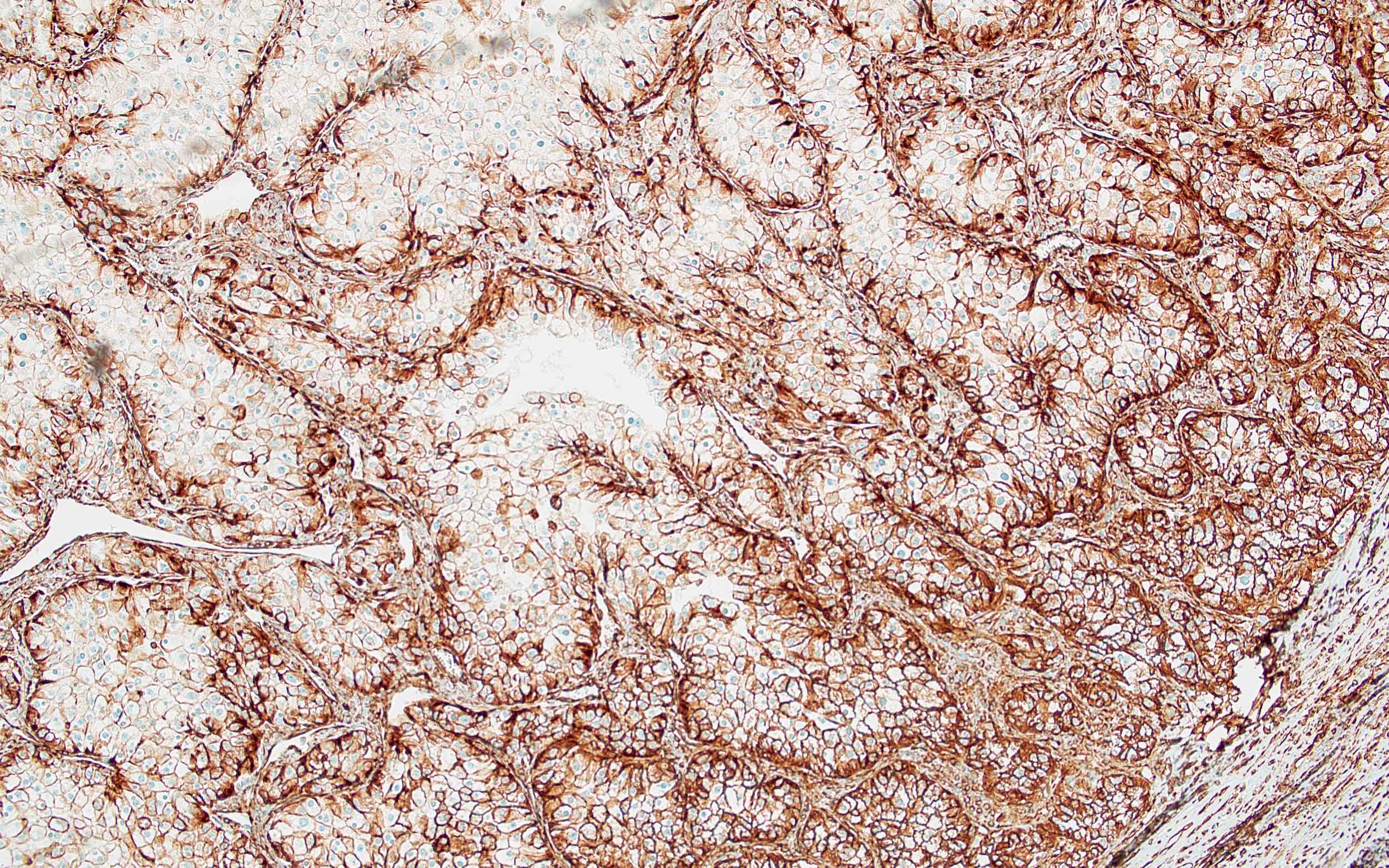 Atypical cells of CCRCC, vimentin+