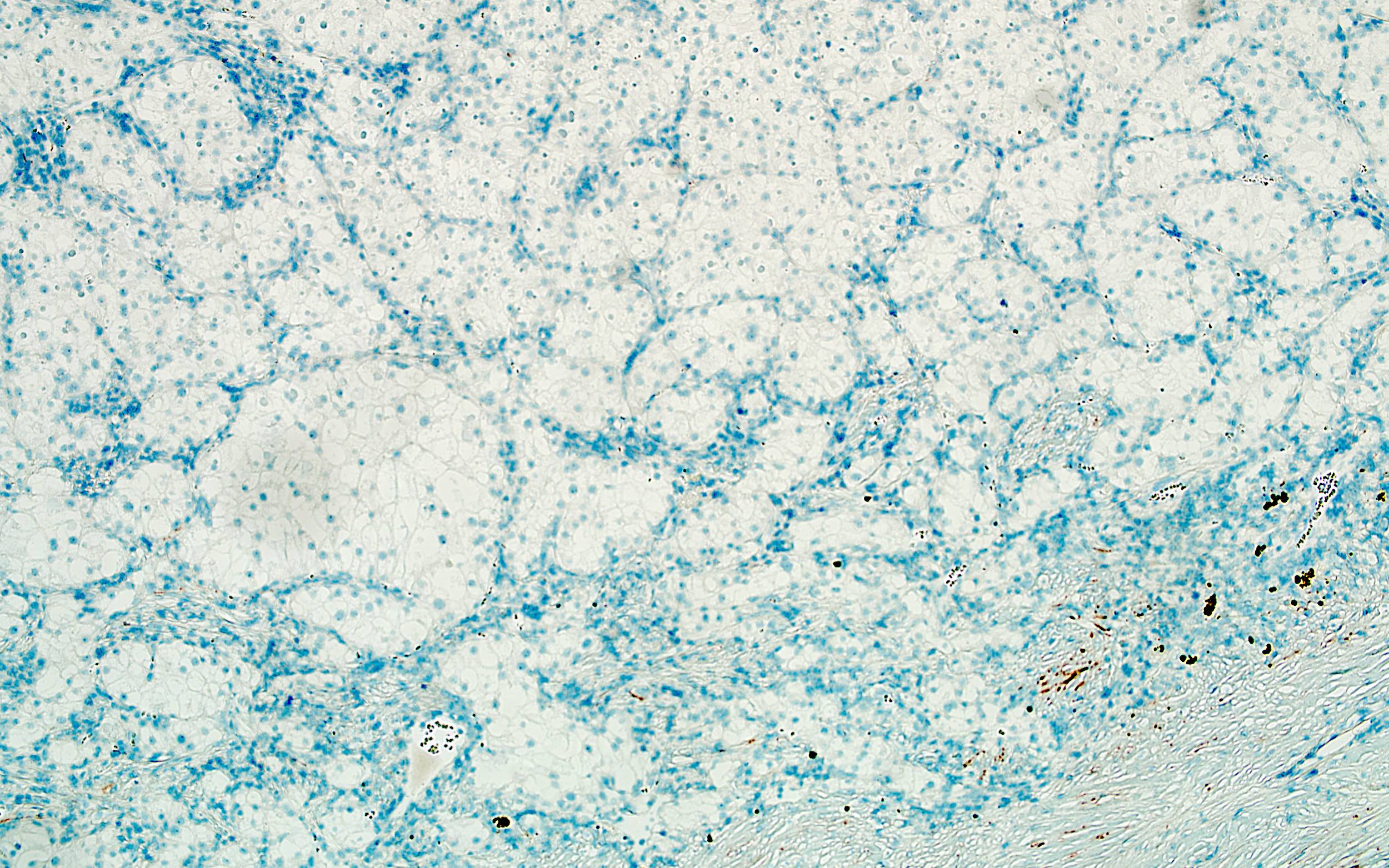 Atypical cells of CCRCC, CK7-