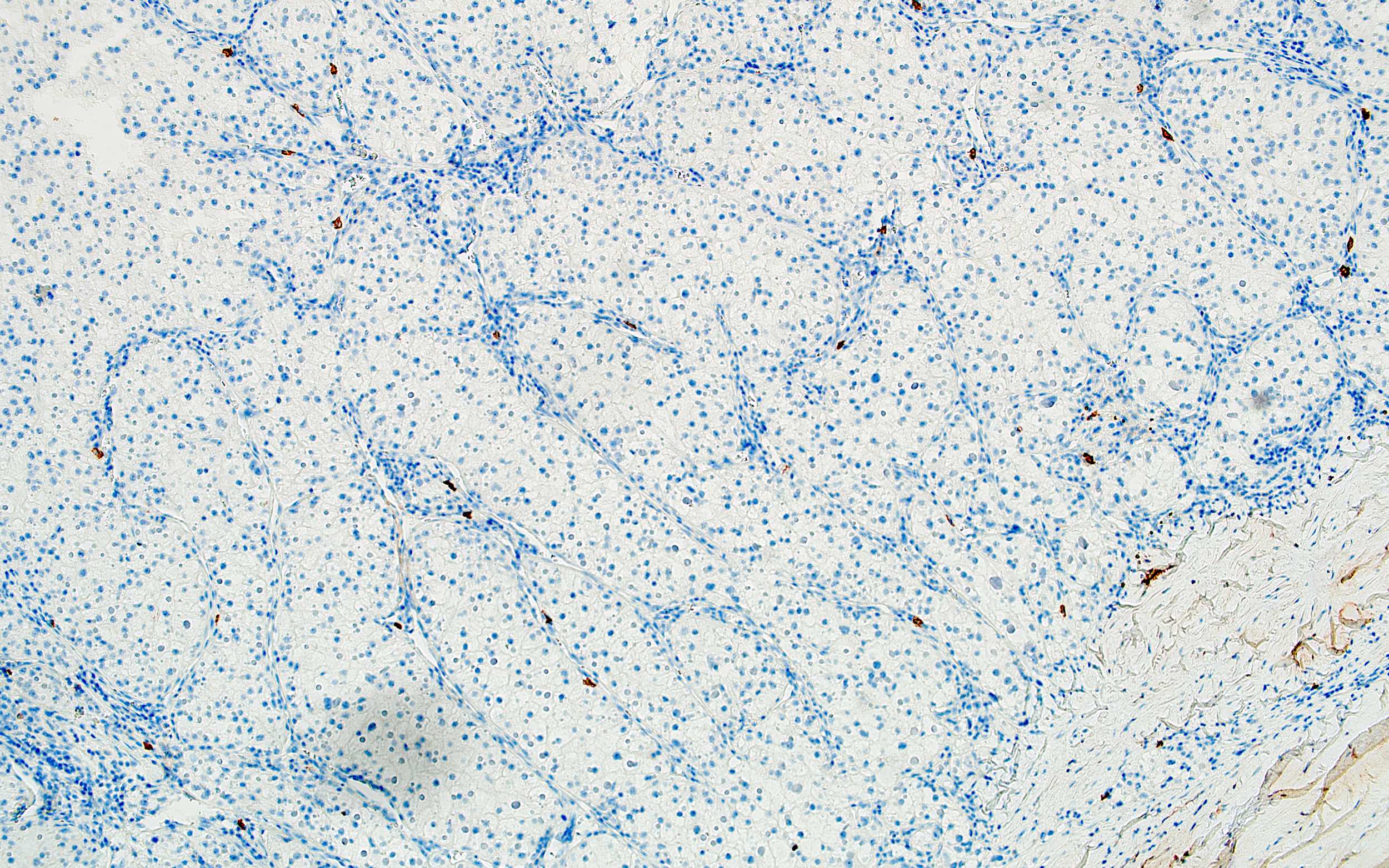 Atypical cells of CCRCC, CD117-