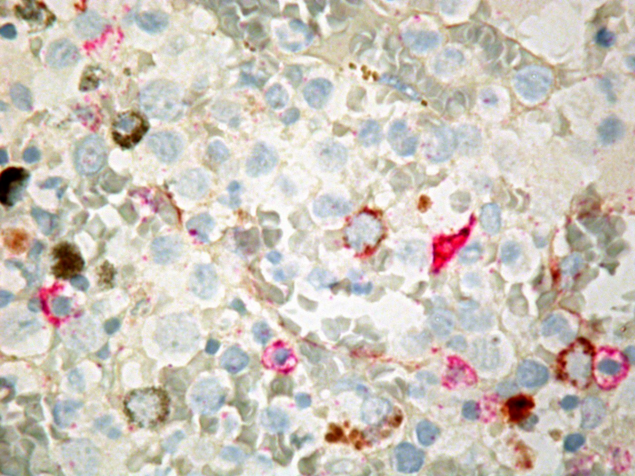 Immunohistochemical double staining (CD27 and CD34)