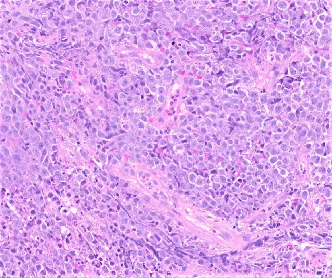 Plasmablastic lymphoma