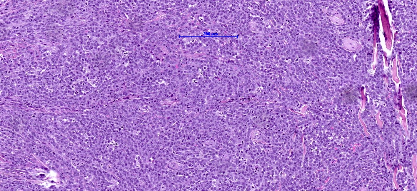 Alveolar rhabdomyosarcoma