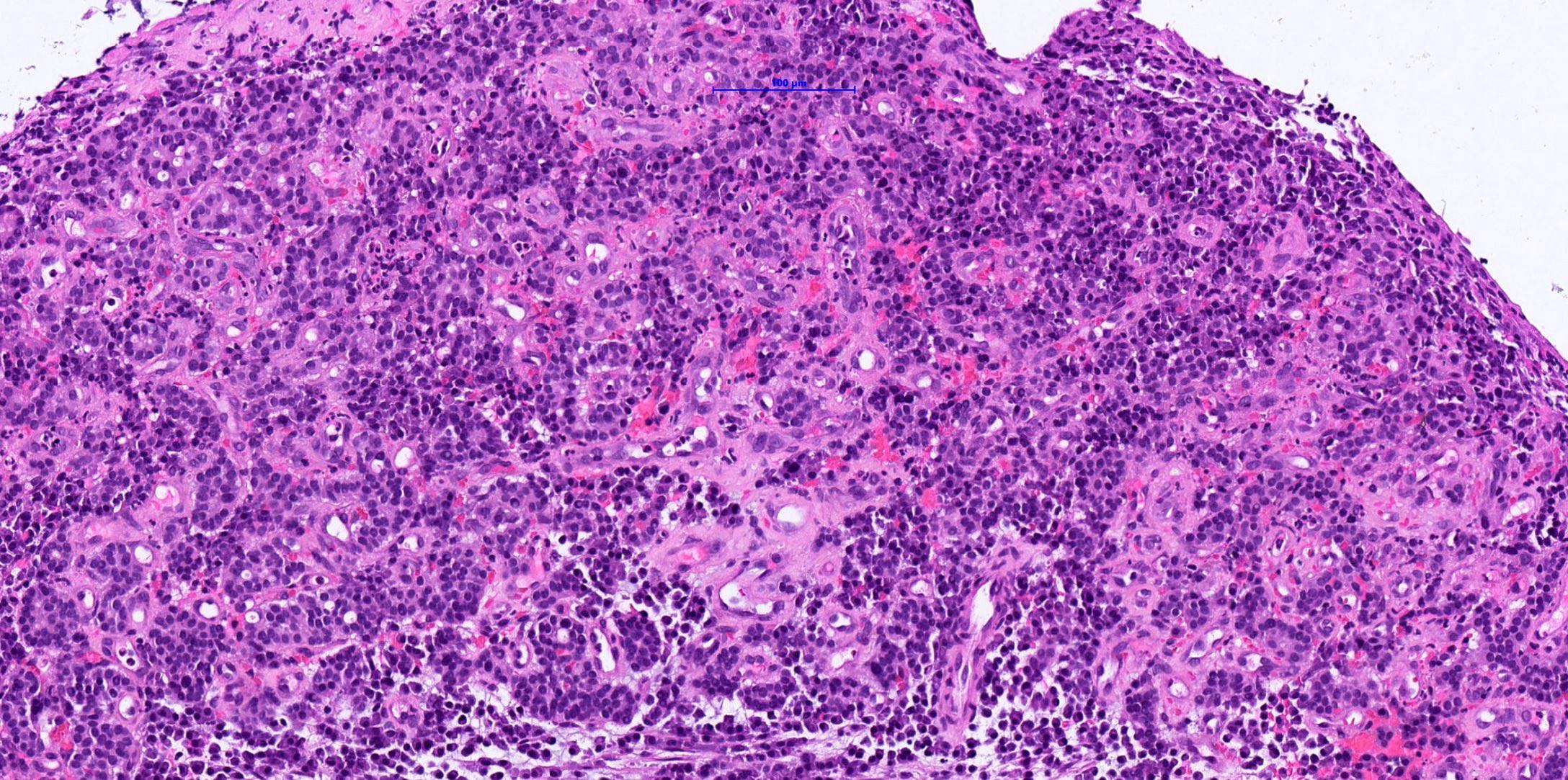 Lung carcinoid