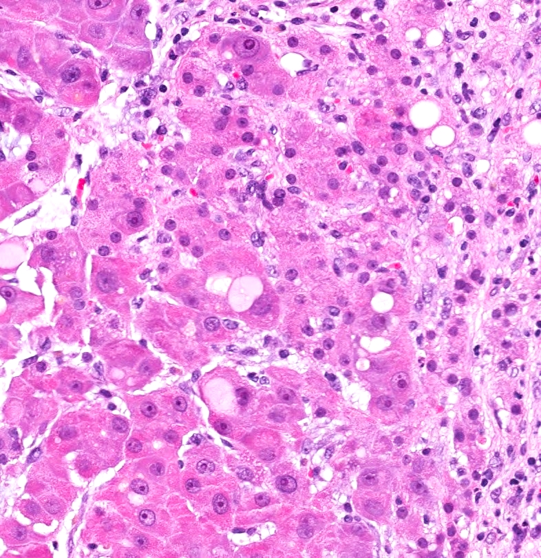 Fibrolamellar carcinoma of the liver, H&E