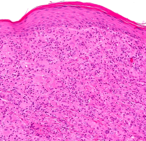 Reticulohistiocytoma of the skin, H&E