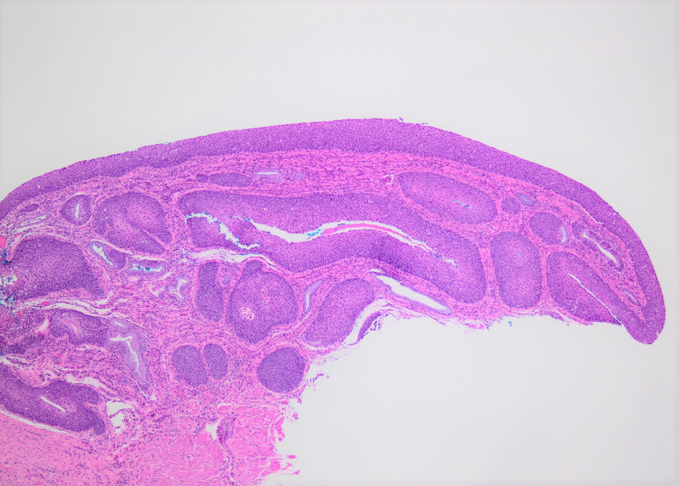 CIN III involving endocervical glands