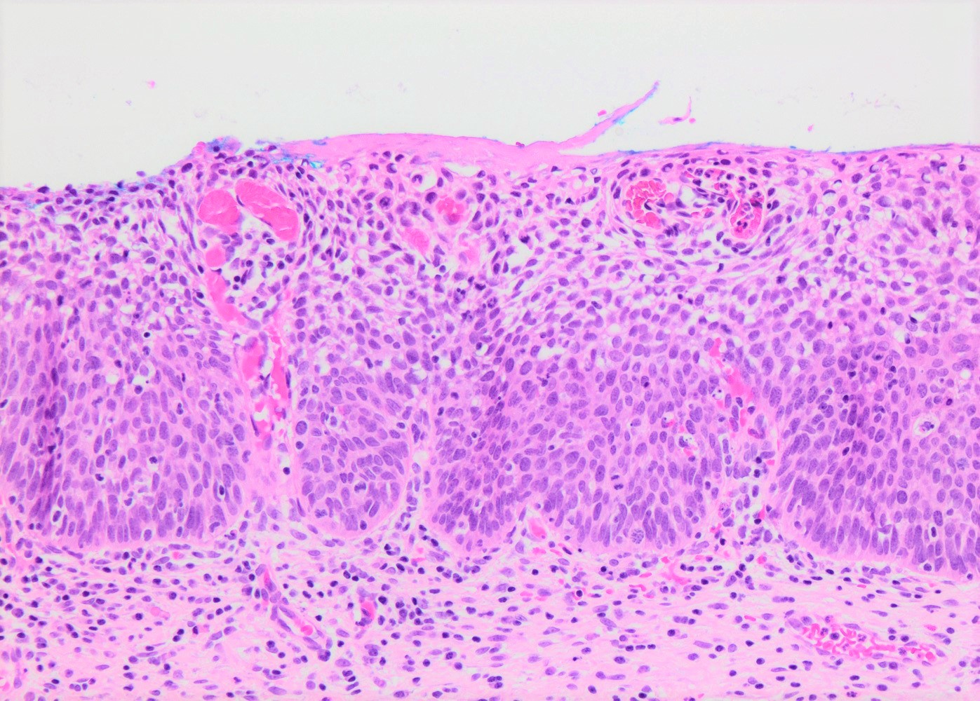 HSIL with superficial keratinization