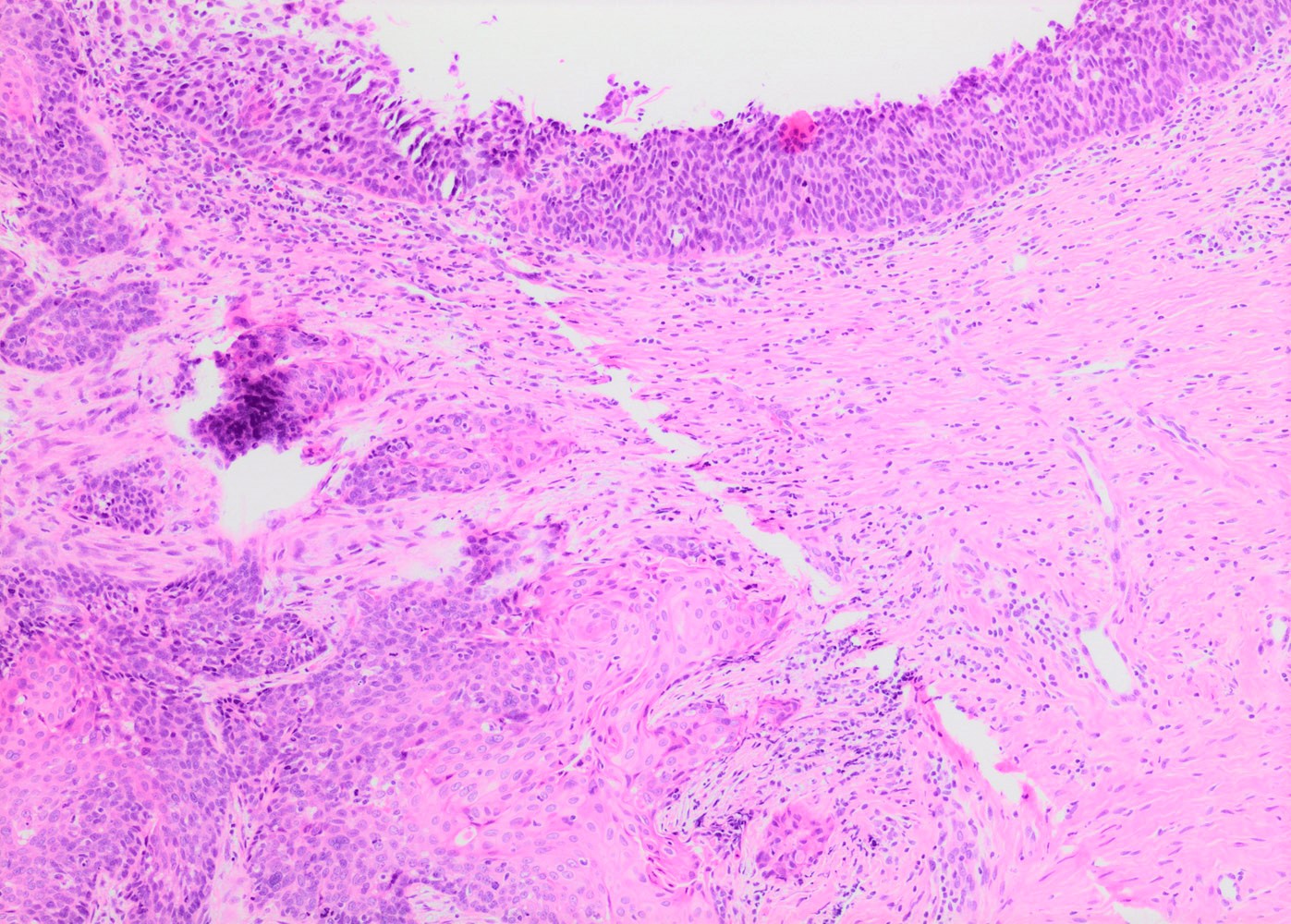 HSIL / CIN III with adjacent squamous cell carcinoma