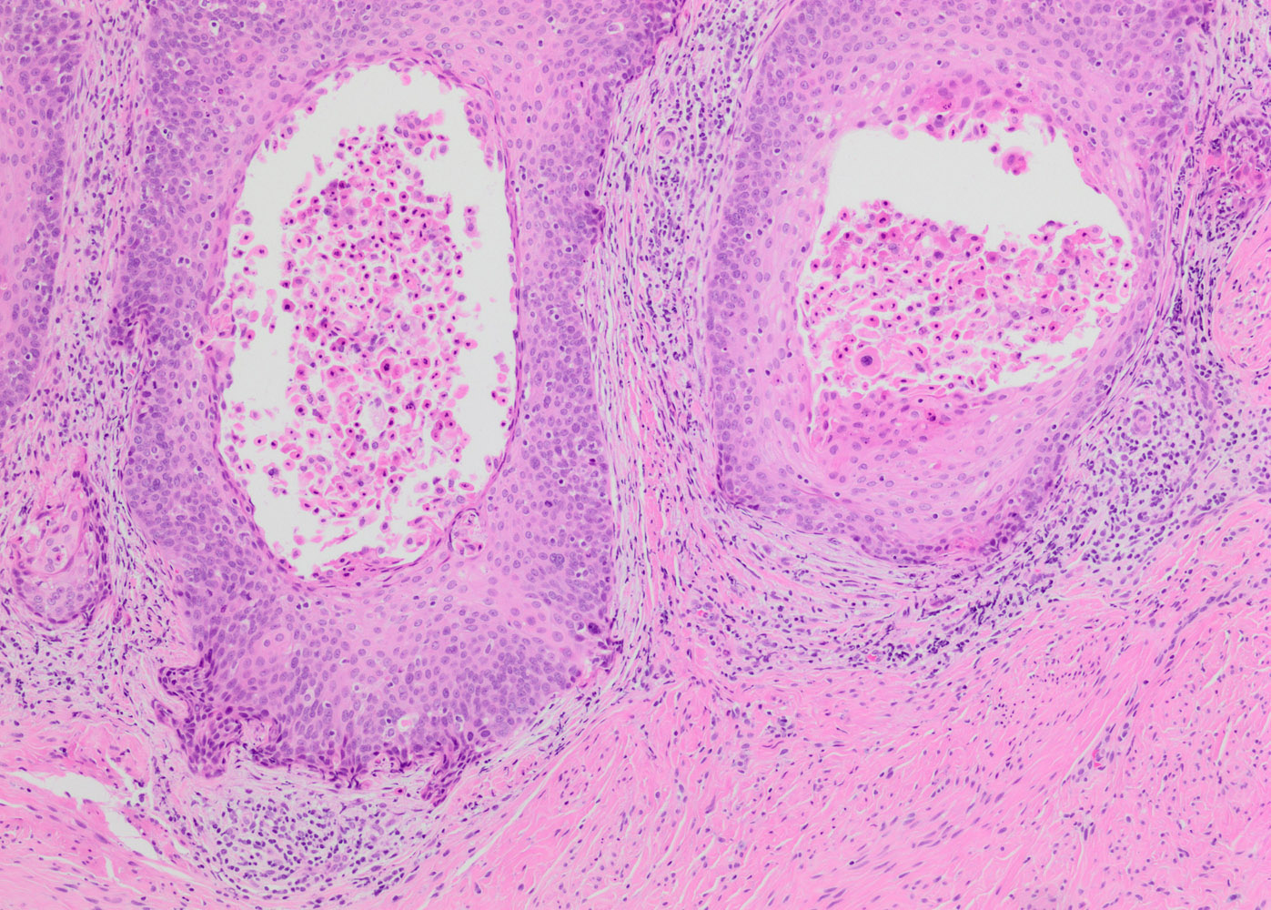 Invasive squamous cell carcinoma