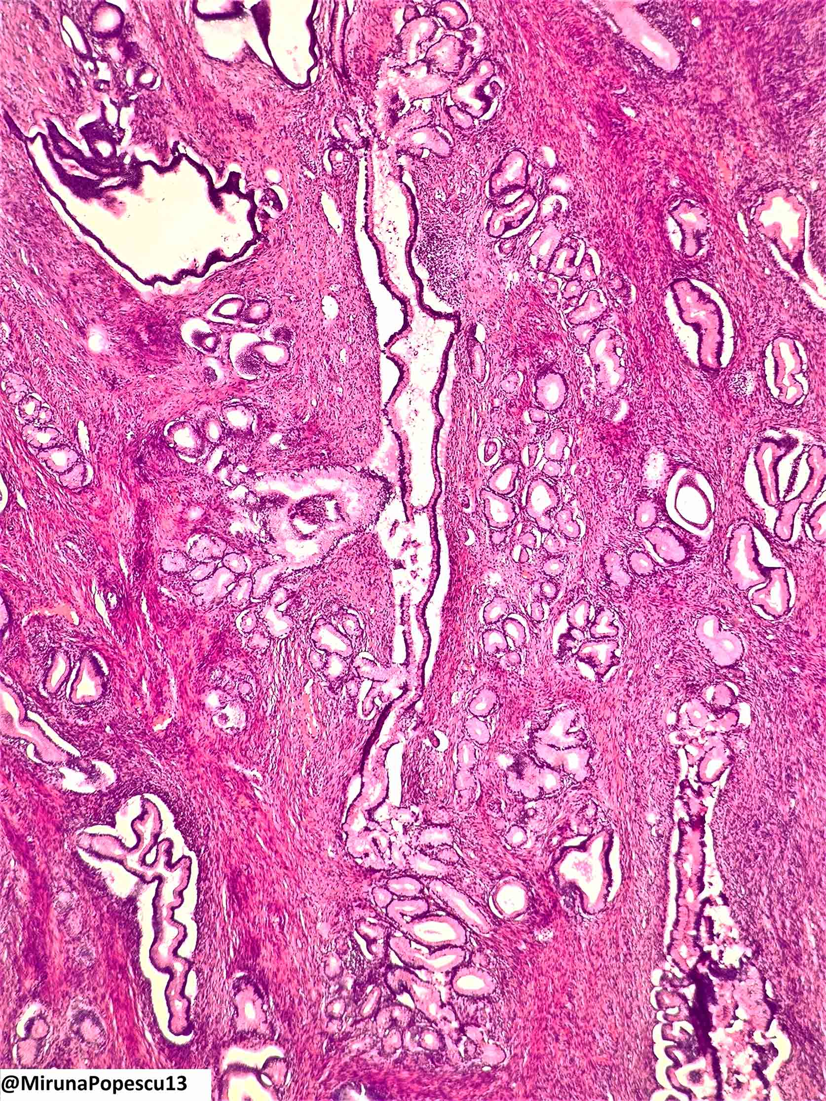 Lobular endocervical glandular hyperplasia