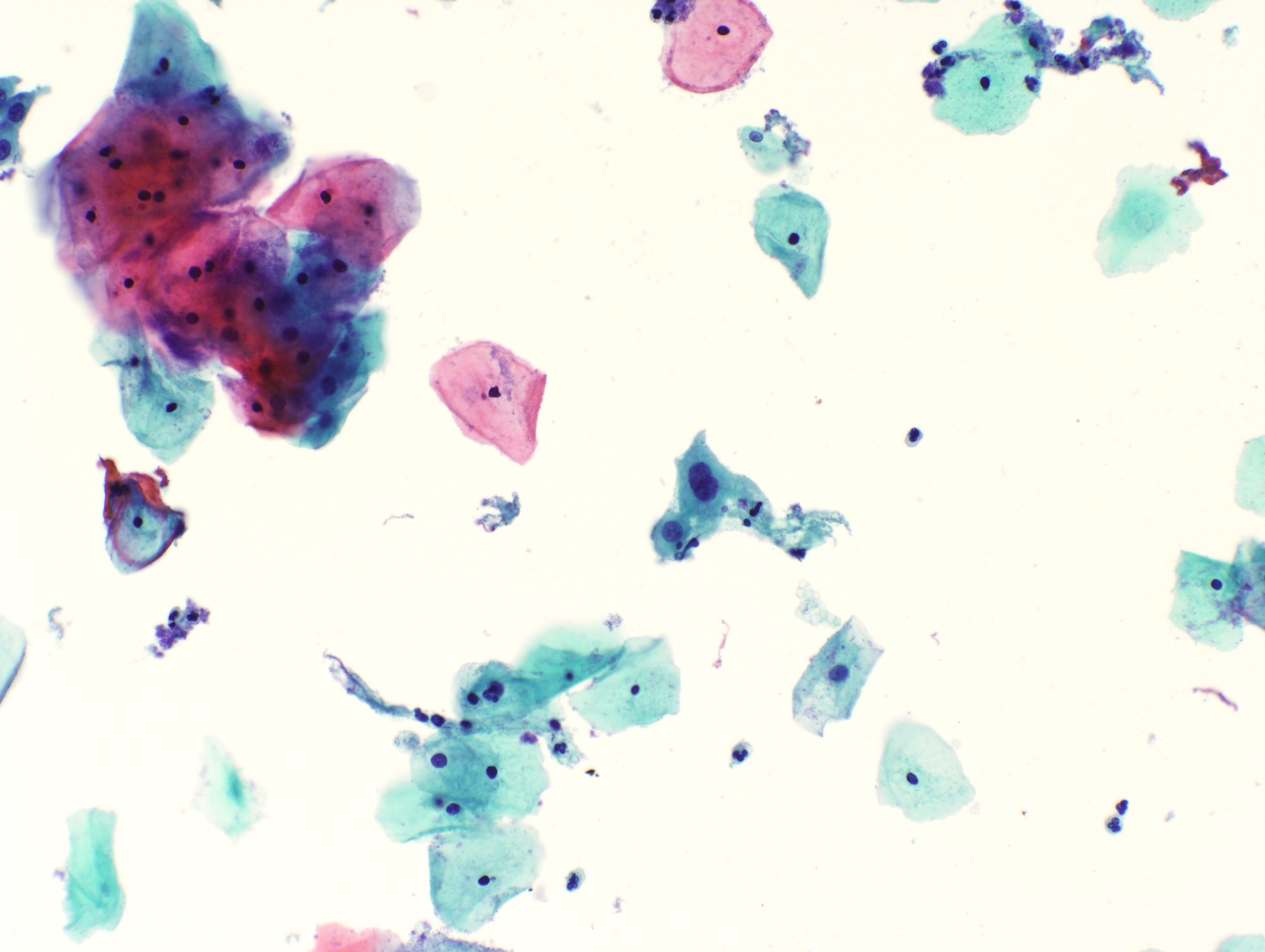 Binucleated cell with hyperchromasia, LSIL
