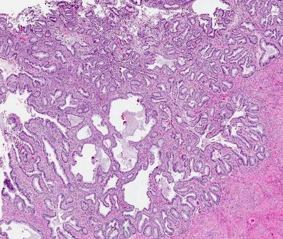 Invasive adenocarcinoma, pattern A