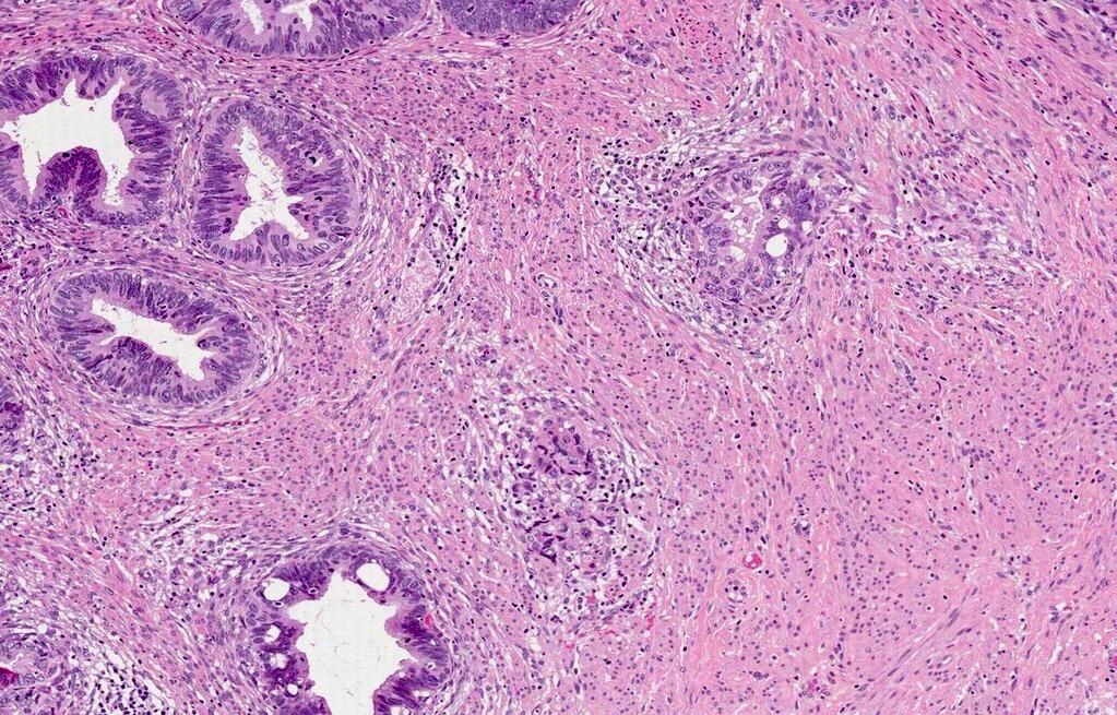 microacinaris adenocarcinoma Hogyan lehet megtudni hogy beteg a prostatitisben