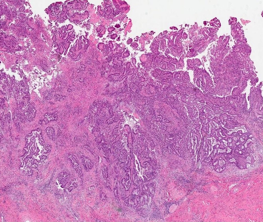 Invasive adenocarcinoma, pattern C