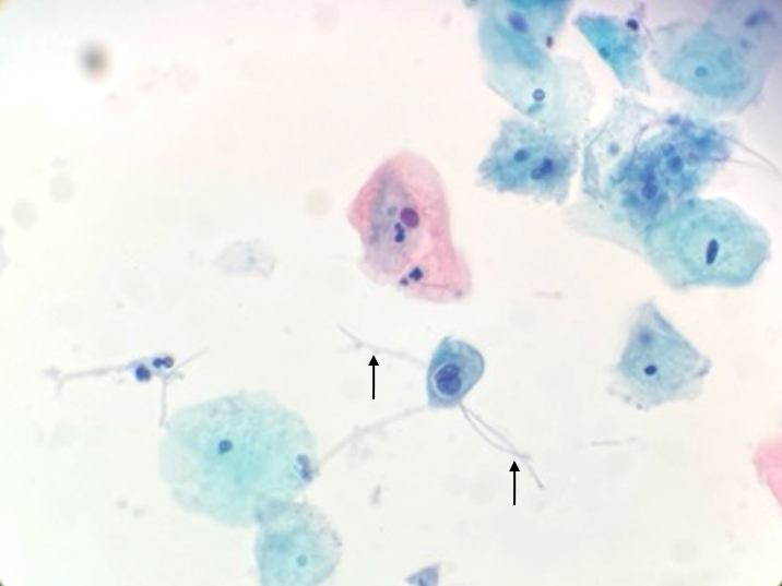 Cytologic smear with <i>Leptothrix</i>
