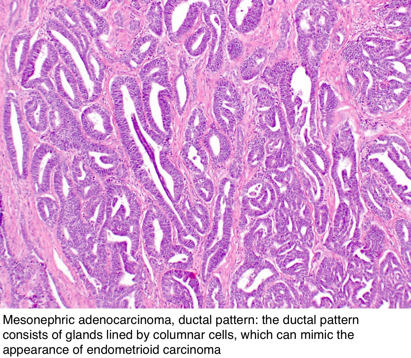 mesonephric adenoma pathology outlines)