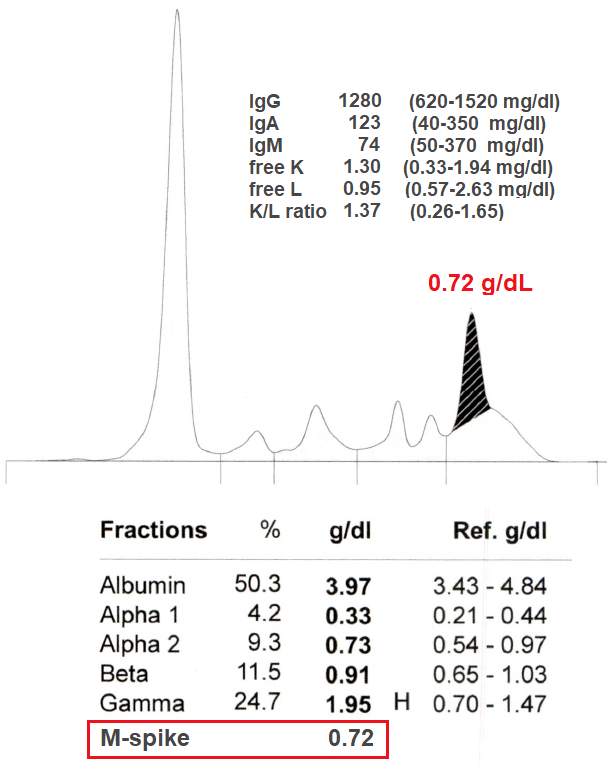 Pathology Outlines Serum free light chain test