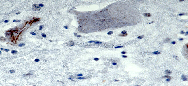 Inclusions immunoreactive for TDP-43