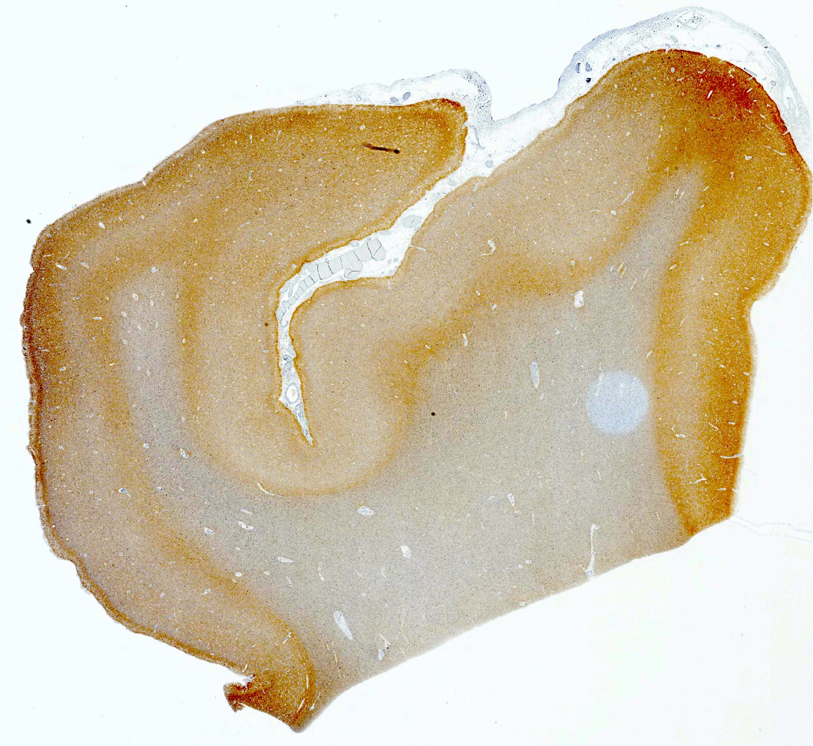 Cortical gray and white matter (tau, 3R)