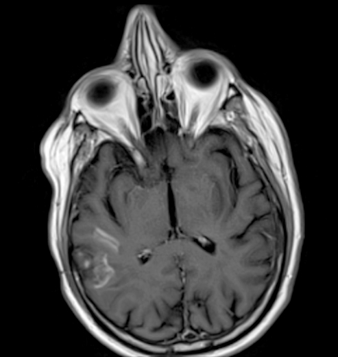 Recent infarcts (T1 postcontrast MRI)