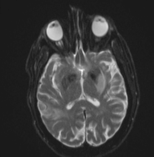 Recent infarcts (diffusion weighted MRI)