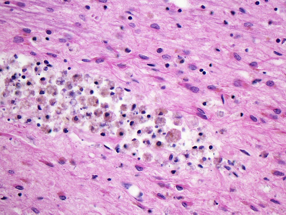 Macrophage infiltration