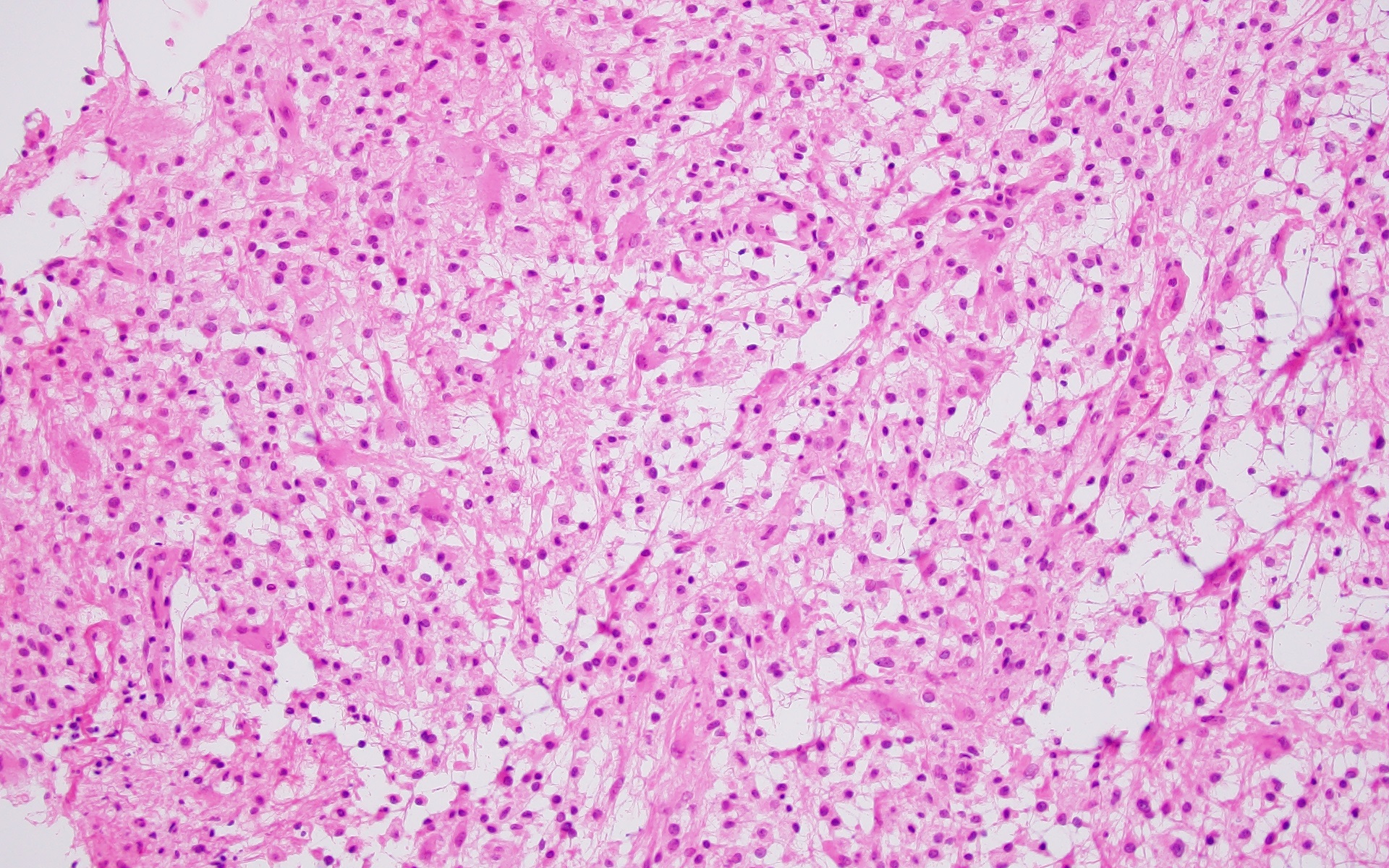 Frozen section of demyelination lesion