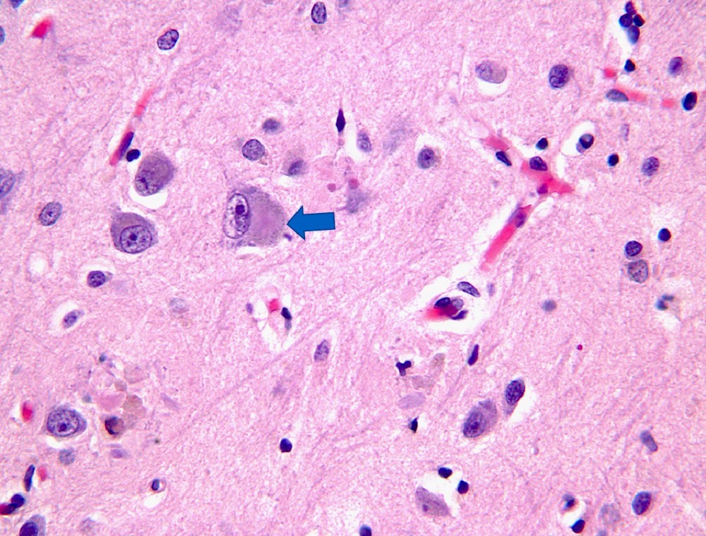 Poorly demarcated cortical Lewy body