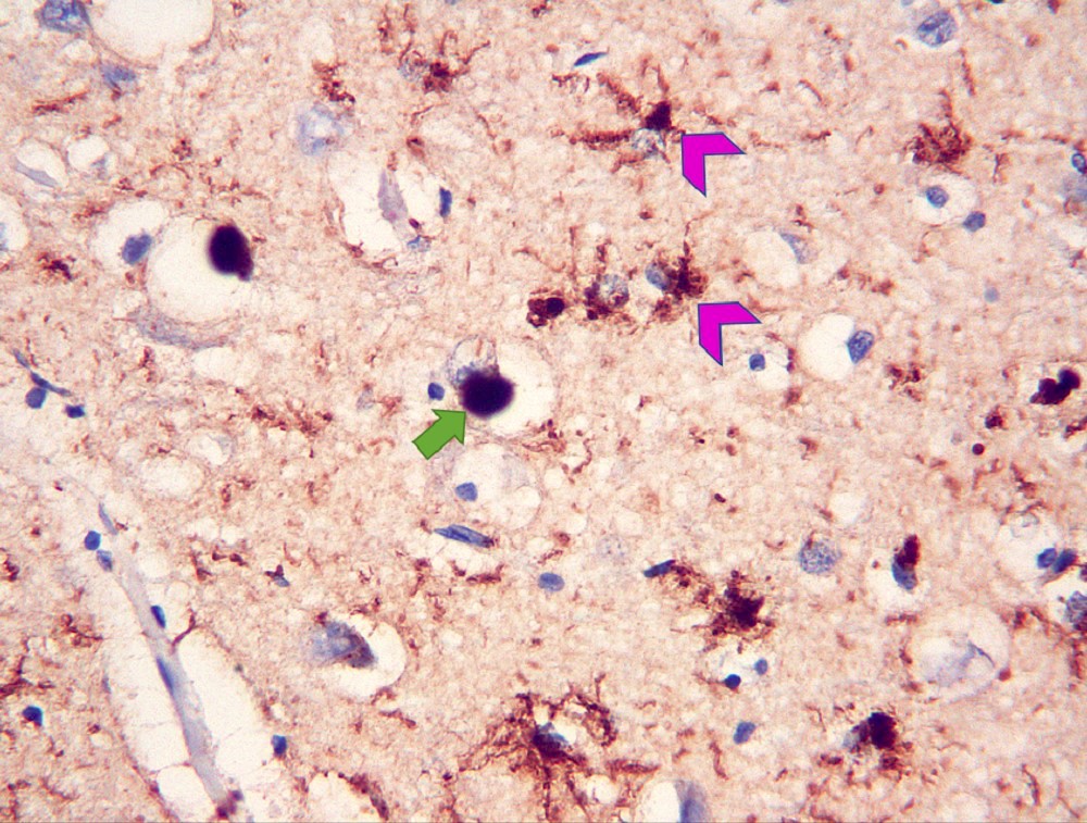 Neocortical alpha synuclein pathology