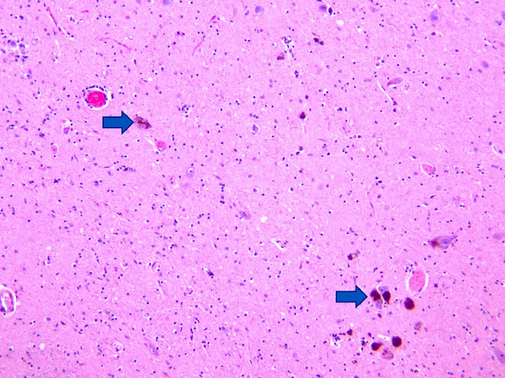 Substantia nigra neuron loss