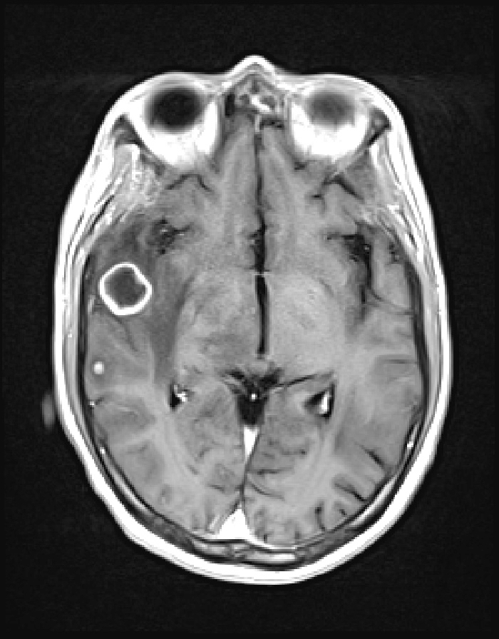 MRI, tuberculous abscess
