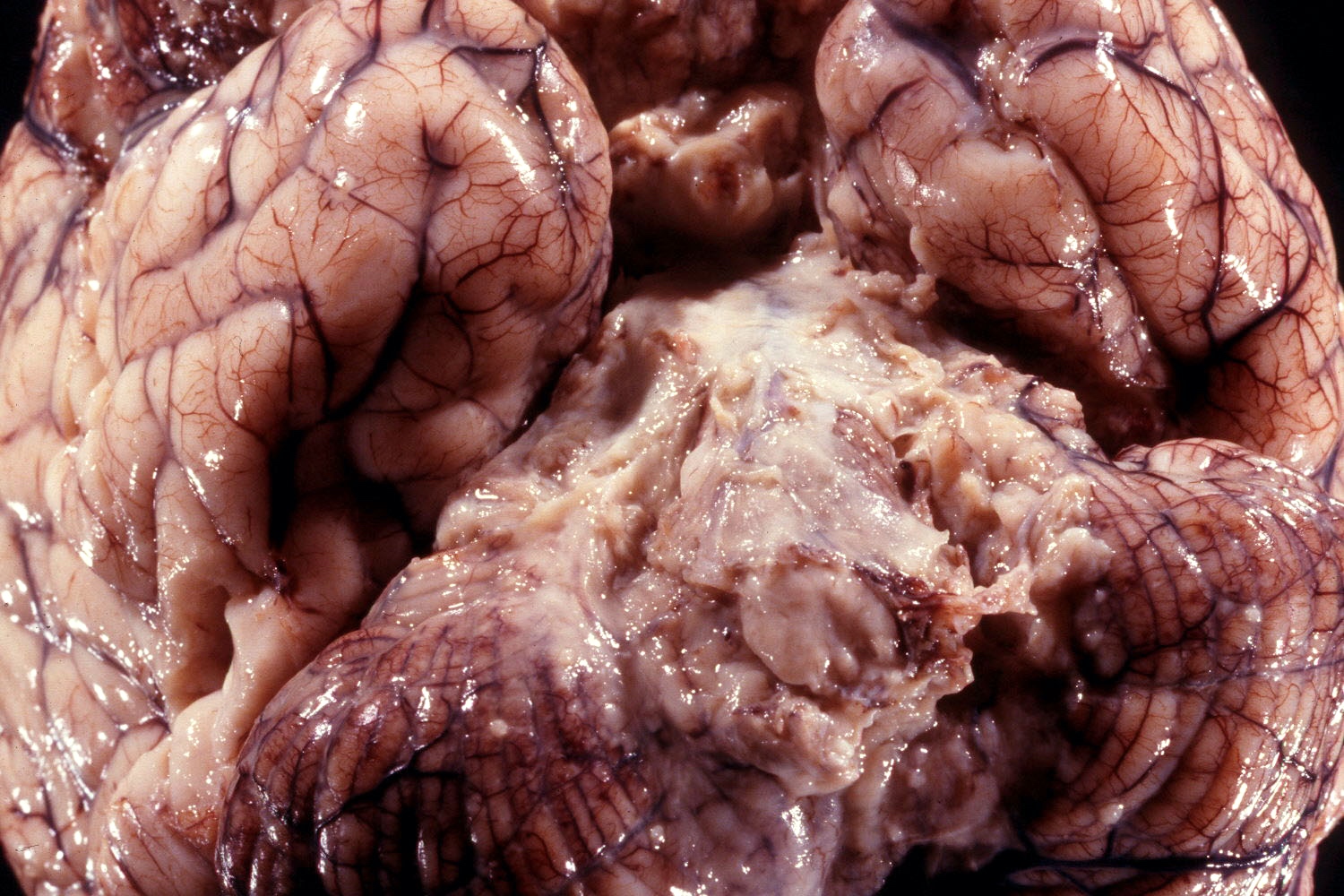Tuberculous meningitis, ventral surface of brain