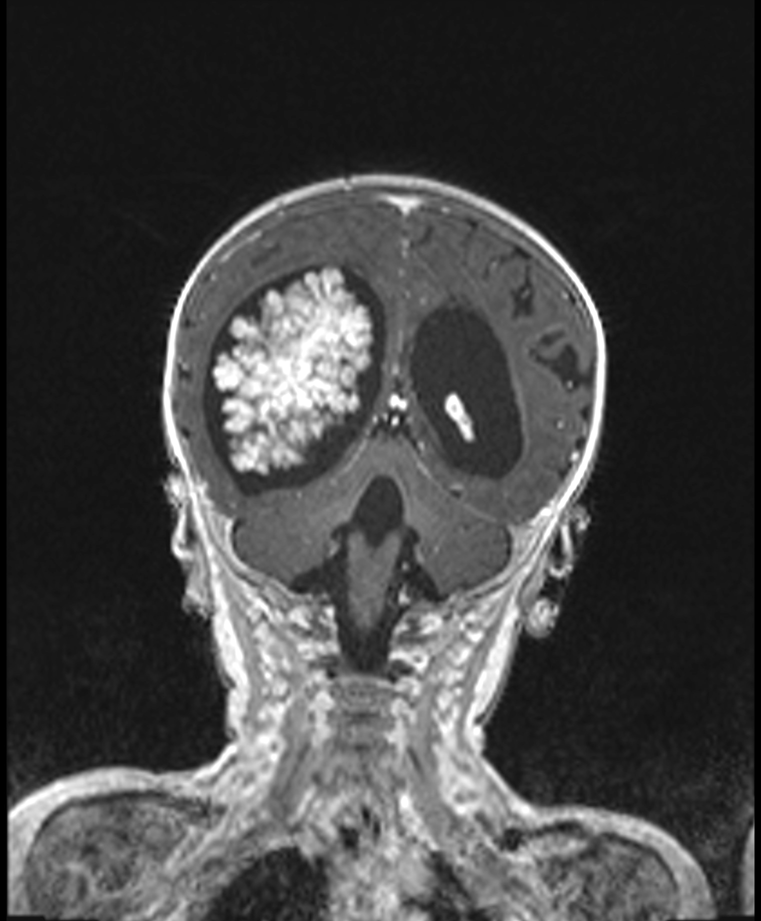 MRI coronal