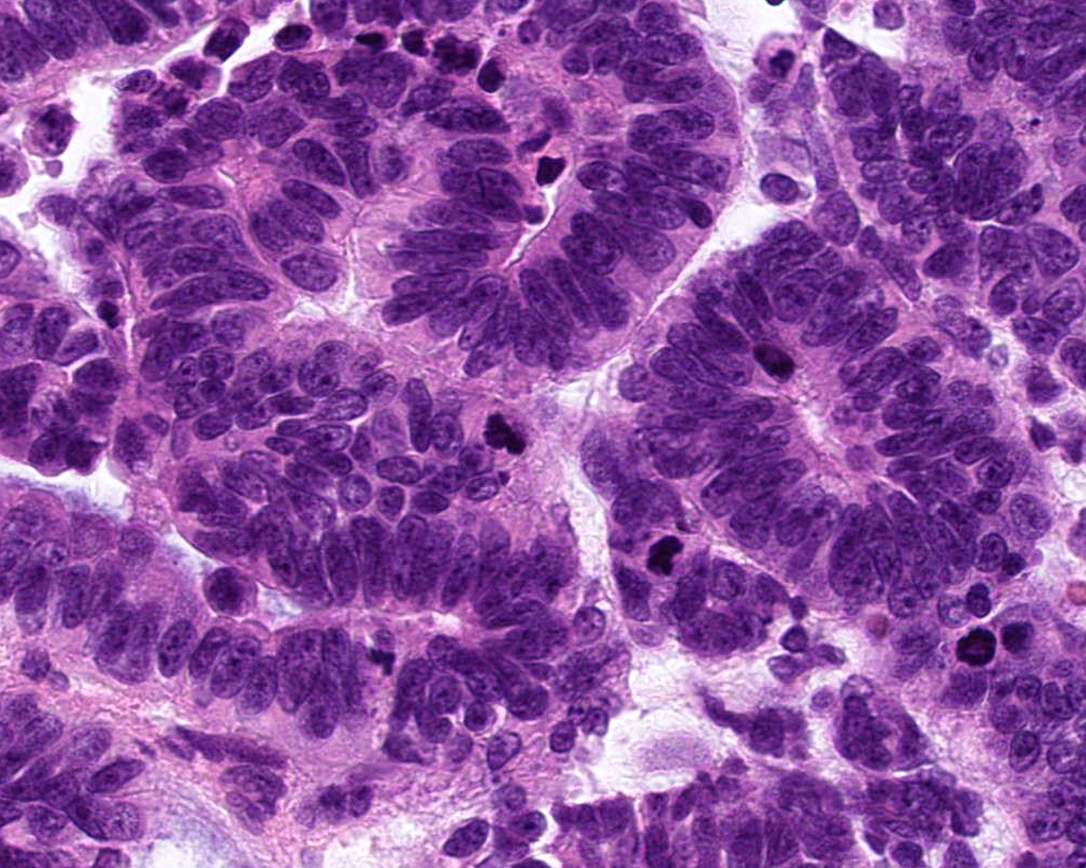 Choroid plexus carcinoma
