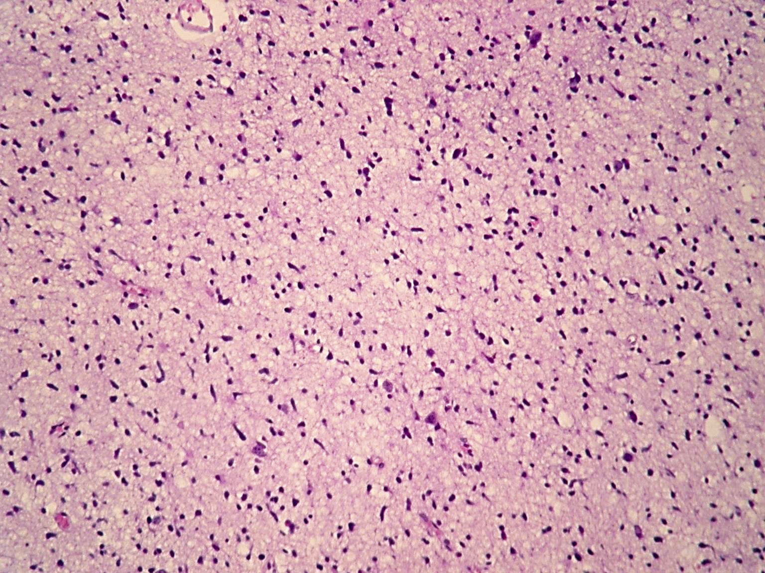 Diffuse astrocytoma, NOS: low power