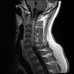 MRI cervical spine ependymoma