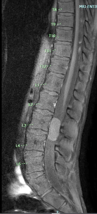 MRI T1 with contrast