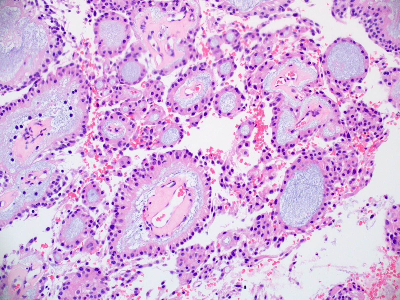 Epithelioid tumor cells