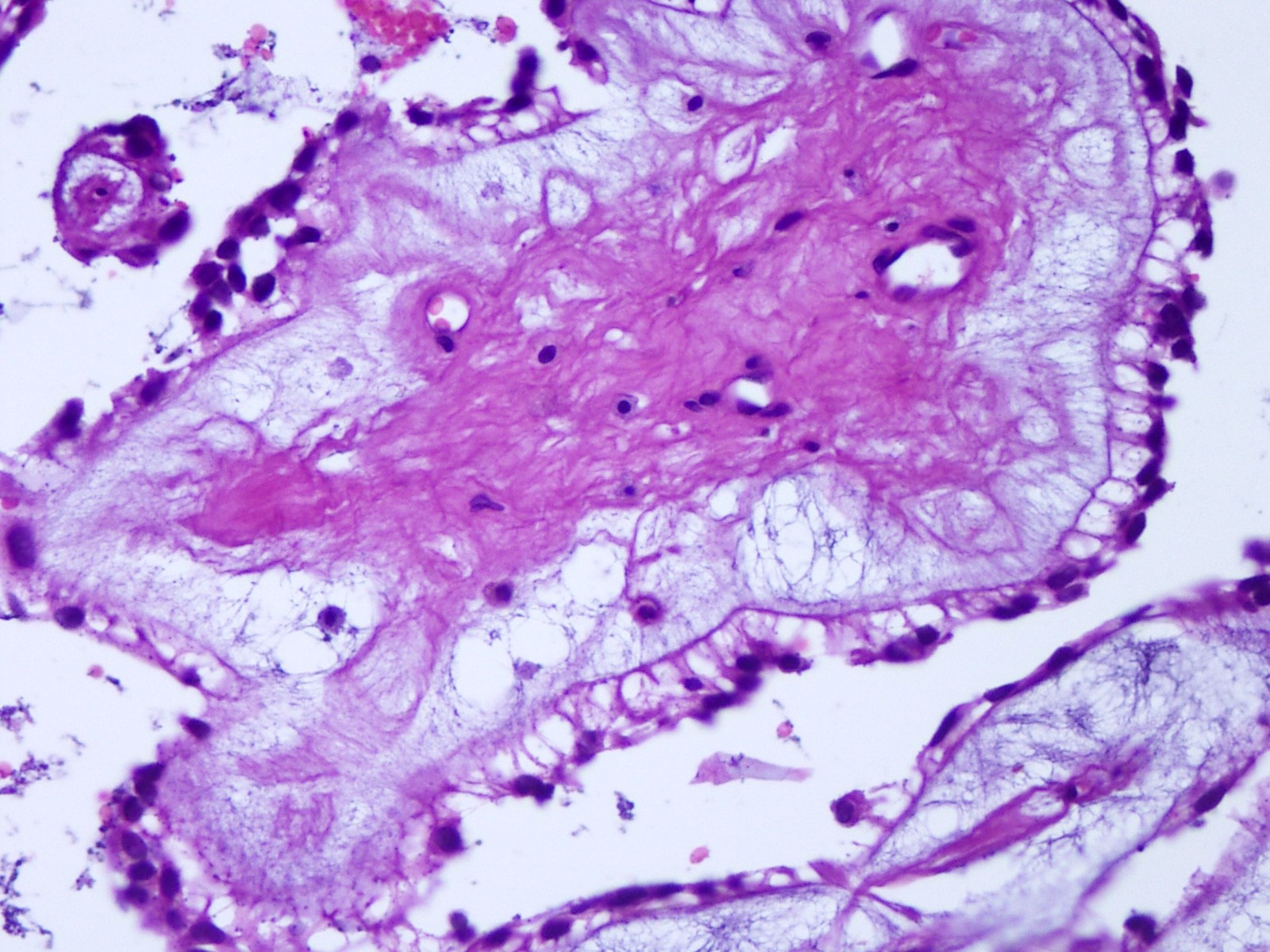 Hyalinized fibrovascular core with myxoid matrix