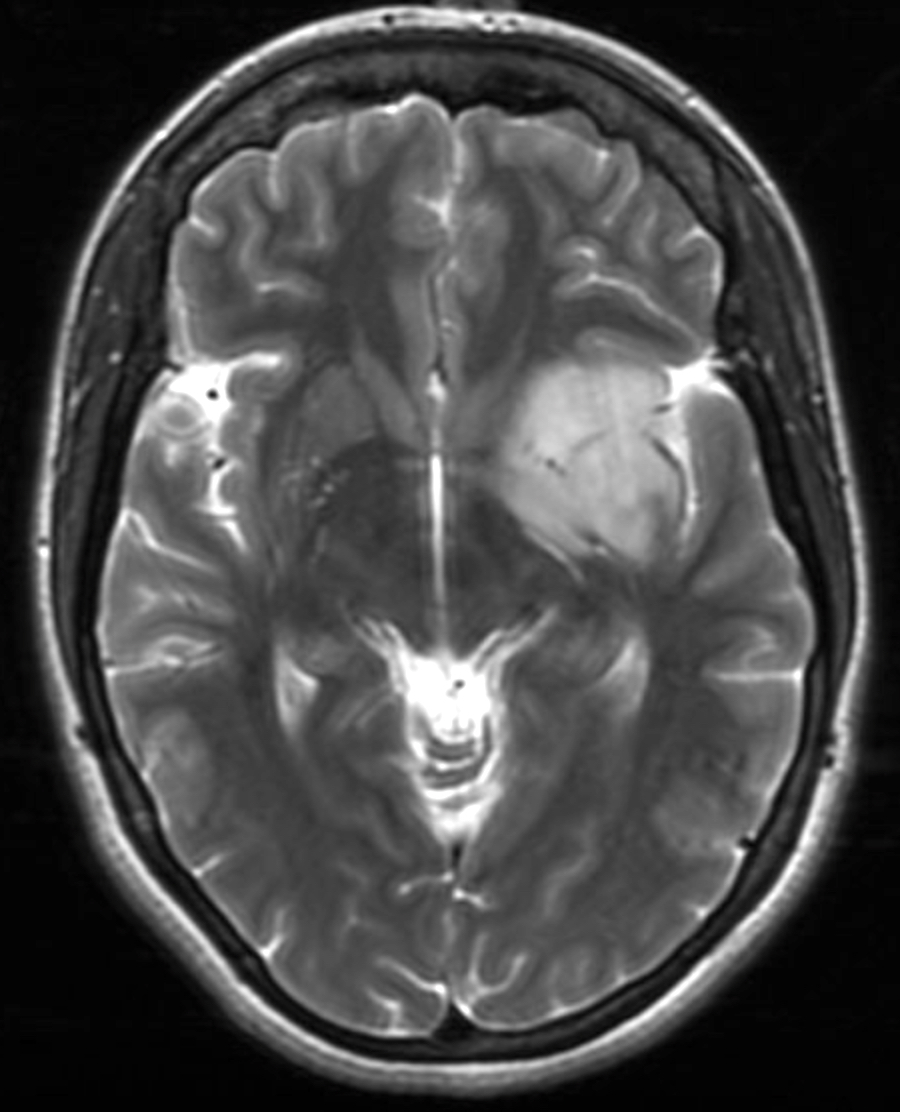 MRI, brain: T2